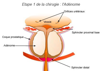 La prostate : ses fonctions et les troubles liées à son dysfonctionnement